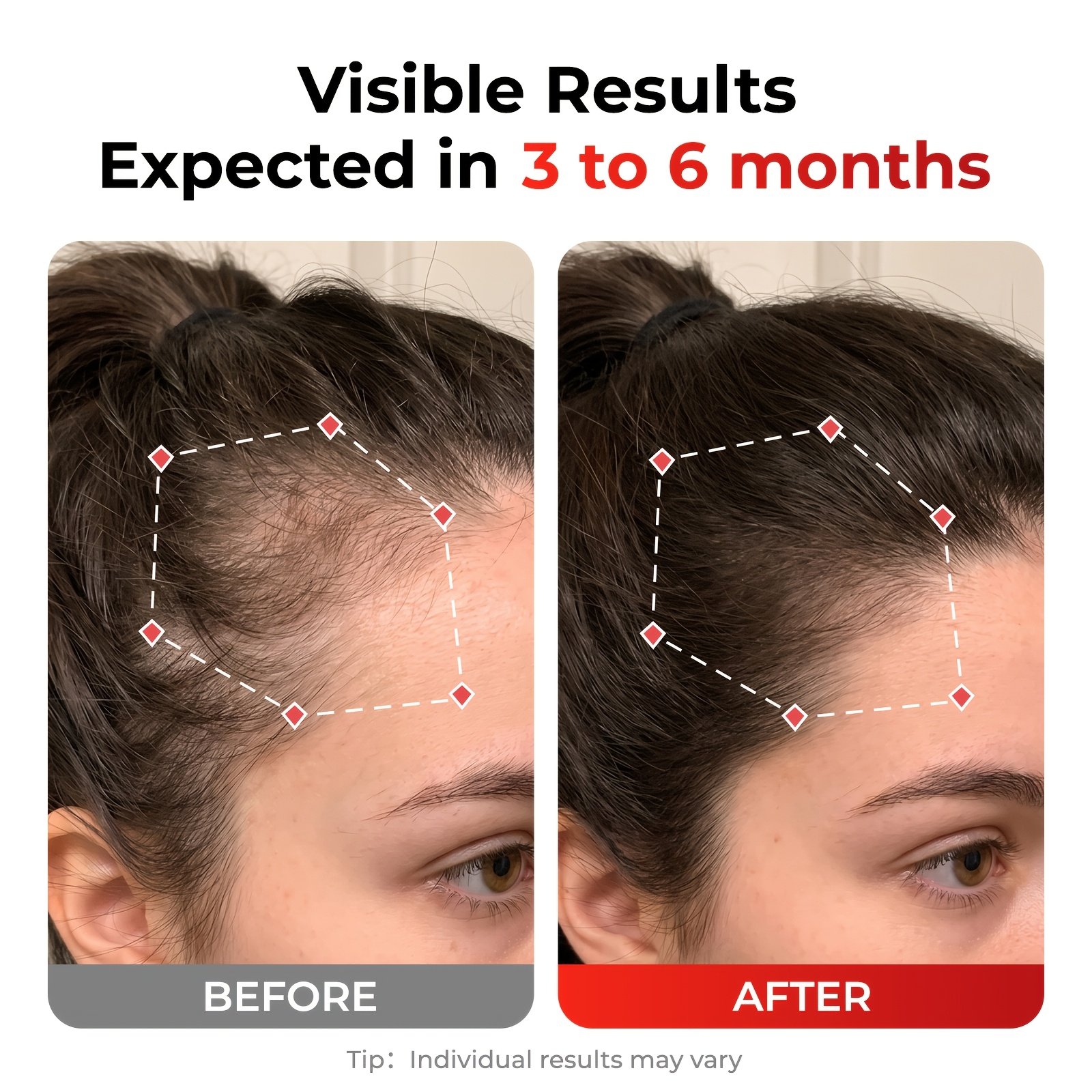 Laser Red Light for Hair Growth Laser Red Light for Hair Growth - Image 7